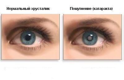 симптомы катаракты
